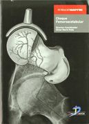 Choque Femoroacetabular