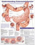 Understanding Colorectal Cancer Anatomical Chart (en Inglés)