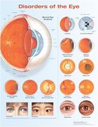 Disorders of the eye Anatomical Chart