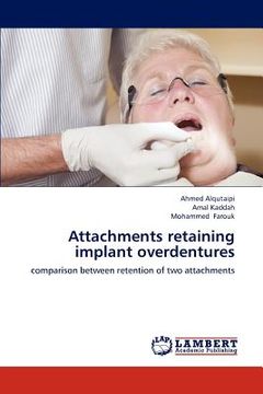 portada attachments retaining implant overdentures (en Inglés)