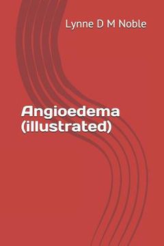 portada Angioedema (illustrated) (en Inglés)
