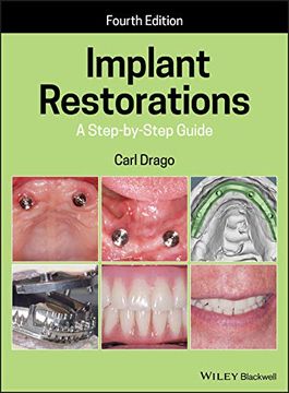 portada Implant Restorations: A Step-By-Step Guide 