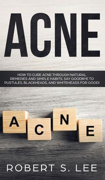 portada Acne: How to Cure Acne through Natural Remedies and Simple Habits. Say Goodbye to Pustules, Blackheads and Whiteheads for Go (in English)