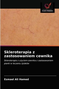 portada Skleroterapia z zastosowaniem cewnika (in Polaco)