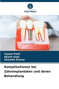 portada Komplikationen bei Zahnimplantaten und deren Behandlung (en Alemán)