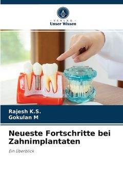 portada Neueste Fortschritte bei Zahnimplantaten (en Alemán)