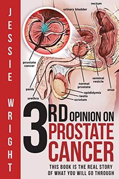 portada 3rd Opinion on Prostate Cancer (en Inglés)