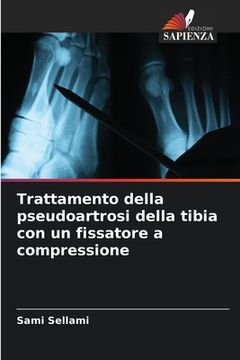 portada Trattamento della pseudoartrosi della tibia con un fissatore a compressione (en Italiano)