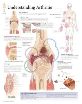 portada understanding arthritis chart: laminated wall chart