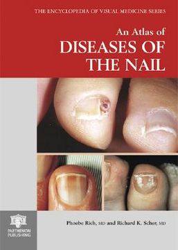 portada An Atlas of Diseases of the Nail (en Inglés)