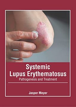 portada Systemic Lupus Erythematosus: Pathogenesis and Treatment 