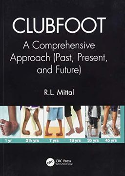 portada Clubfoot: A Comprehensive Approach (Past, Present, and Future) (en Inglés)