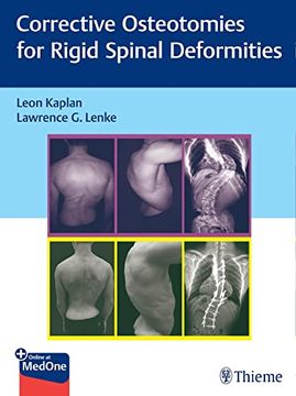 portada Corrective Osteotomies for Rigid Spinal Deformities (in English)