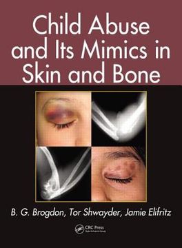 portada Child Abuse and Its Mimics in Skin and Bone (en Inglés)