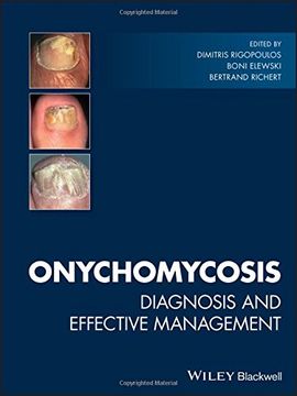 portada Onychomycosis: Diagnosis and Effective Management (en Inglés)
