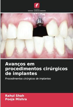 portada Avanços em Procedimentos Cirúrgicos de Implantes: Procedimentos Cirúrgicos de Implantes: (in Portuguese)