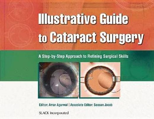 illustrative guide to cataract surgery,a step-by-step approach to refining surgical skills