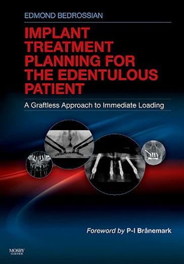 implant treatment planning for the edentulous patient,a graftless approach to immediate loading