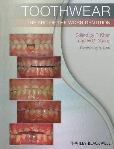 Toothwear: The ABC of the Worn Dentition (en Inglés)