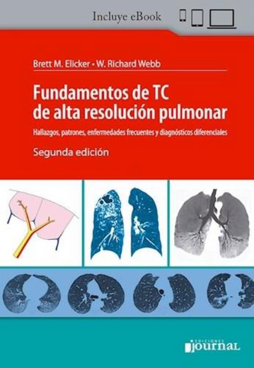 Fundamentos de TC de Alta Resolución Pulmonar. Hallazgos, patrones, enfermedades frecuentes y diagnósticos diferenciales (in Spanish)