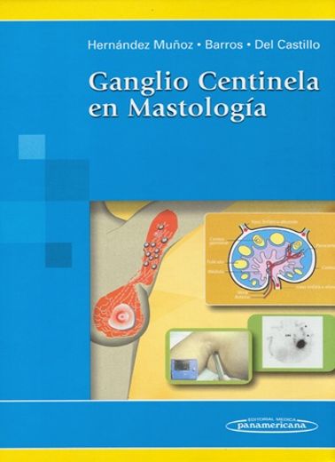 Ganglio centinela en Mastología