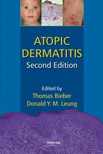 Atopic Dermatitis (en Inglés)