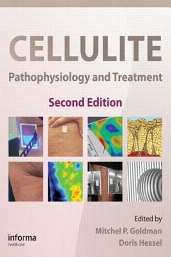 Cellulite: Pathophysiology and Treatment (en Inglés)