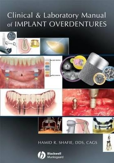 clinical and laboratory manual of implant overdentures (en Inglés)
