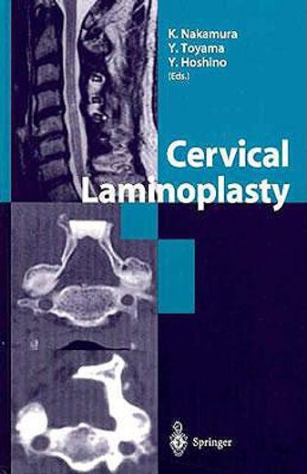 cervical laminoplasty (en Inglés)